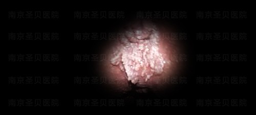 南京市中医院治疗hpv