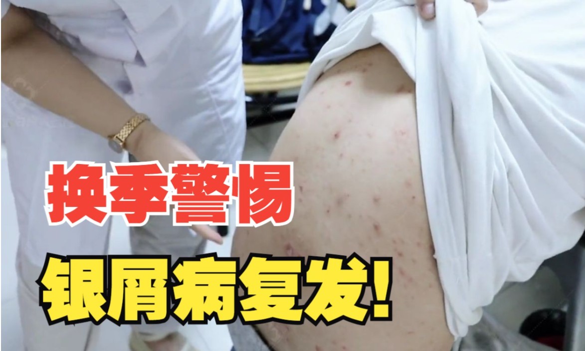 牛皮皮癣忌口哪些食物