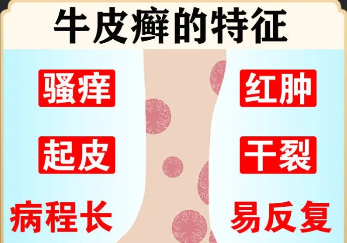 牛皮皮癣图片早期症状能医好吗