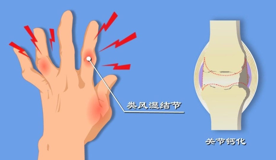 昆明类风湿专科医院!得了类风湿，饮食需要调整吗?