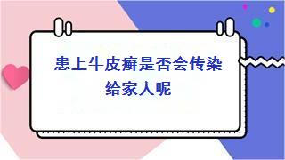 患上牛皮癣是否会传染给家人呢