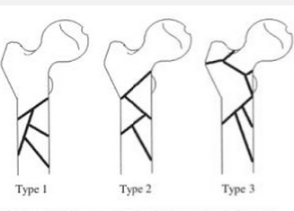施乐辉 Russell-Taylor髓内针系统(股骨、胫骨、肱骨)
