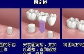 志仁义齿 定制式义齿  活动修复体