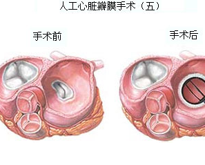 人工心脏瓣膜真实图片图片