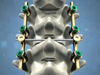 兴达 骨接合植入物 脊柱前路内固定器