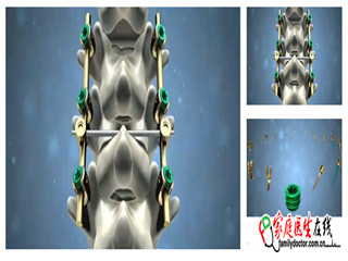 德骼拜尔 脊柱后路内固定系统(不锈钢)