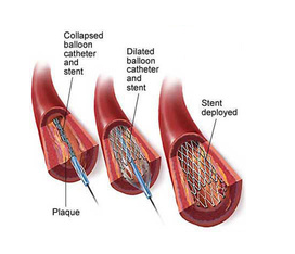 维科医疗 冠状动脉支架