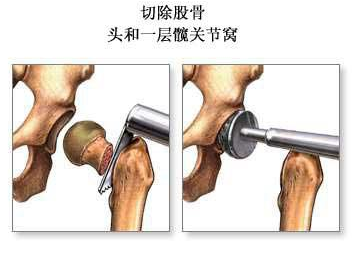 上海手术 1 2 3髋关节骨撬