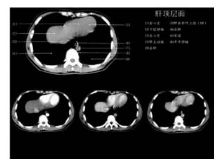 -IQQA肝脏CT影像解读分析系统