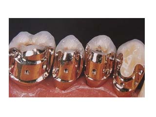 金属烤瓷固定义齿