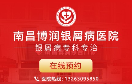 南昌牛皮癣医院 