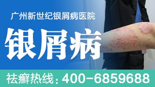 银屑病