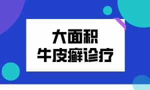 南京华厦银屑病专病门诊大面积牛皮癣