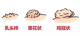 南京尖锐湿疣治疗医院
