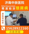 济南牛皮癣医院