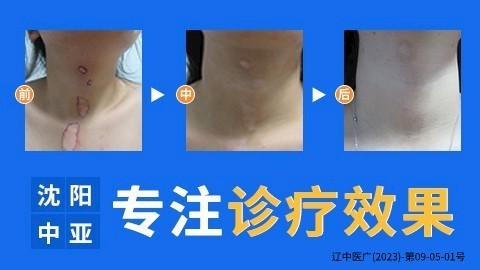 白山白癜风医院