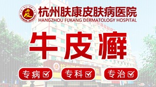 杭州牛皮癣医院